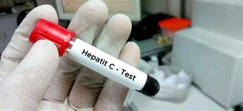 hepatit c nasıl bulaşır